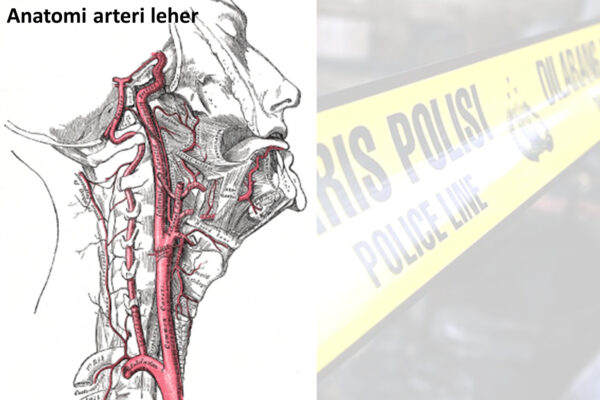 Diagnosis Diferensial Trauma Leher • Trauma tembus leher • Trauma tumpul pada leher o Diseksi arteri vertebralis dan karotis o Pencekikan o Cedera leher • Cedera serviks o Fraktur dan dislokasi serviks o Cedera serviks (anak-anak) o Pembersihan tulang belakang leher • Syok neurogenik • Cedera sumsum tulang belakang